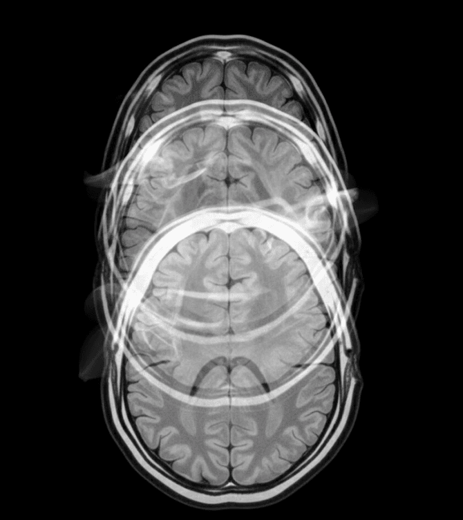 Brain MRI